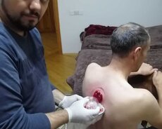 Hicama və Zəli Terapiya Tibbi islamla mezacşunaslıq elminilə